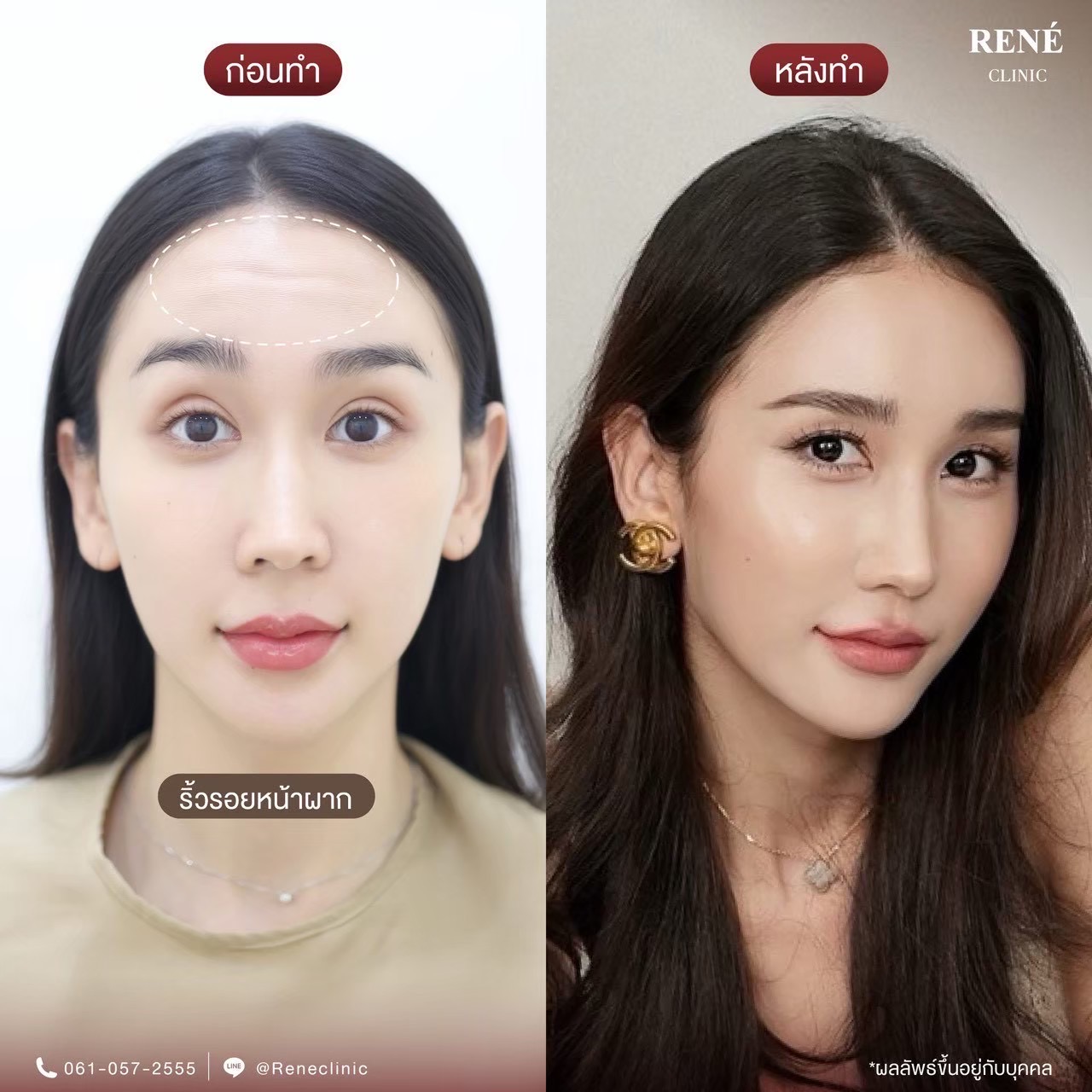 รีวิว Botox #14