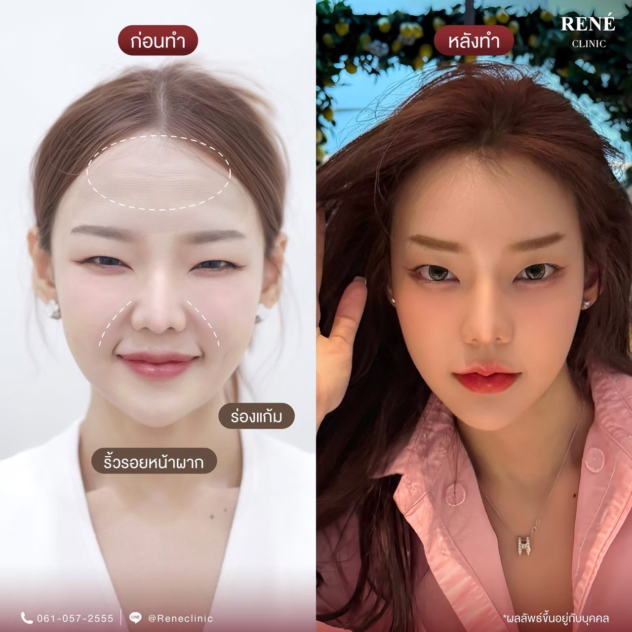 รีวิว Botox #17