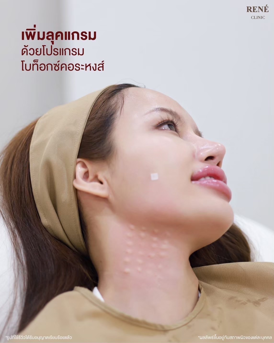 รีวิว Botox #18