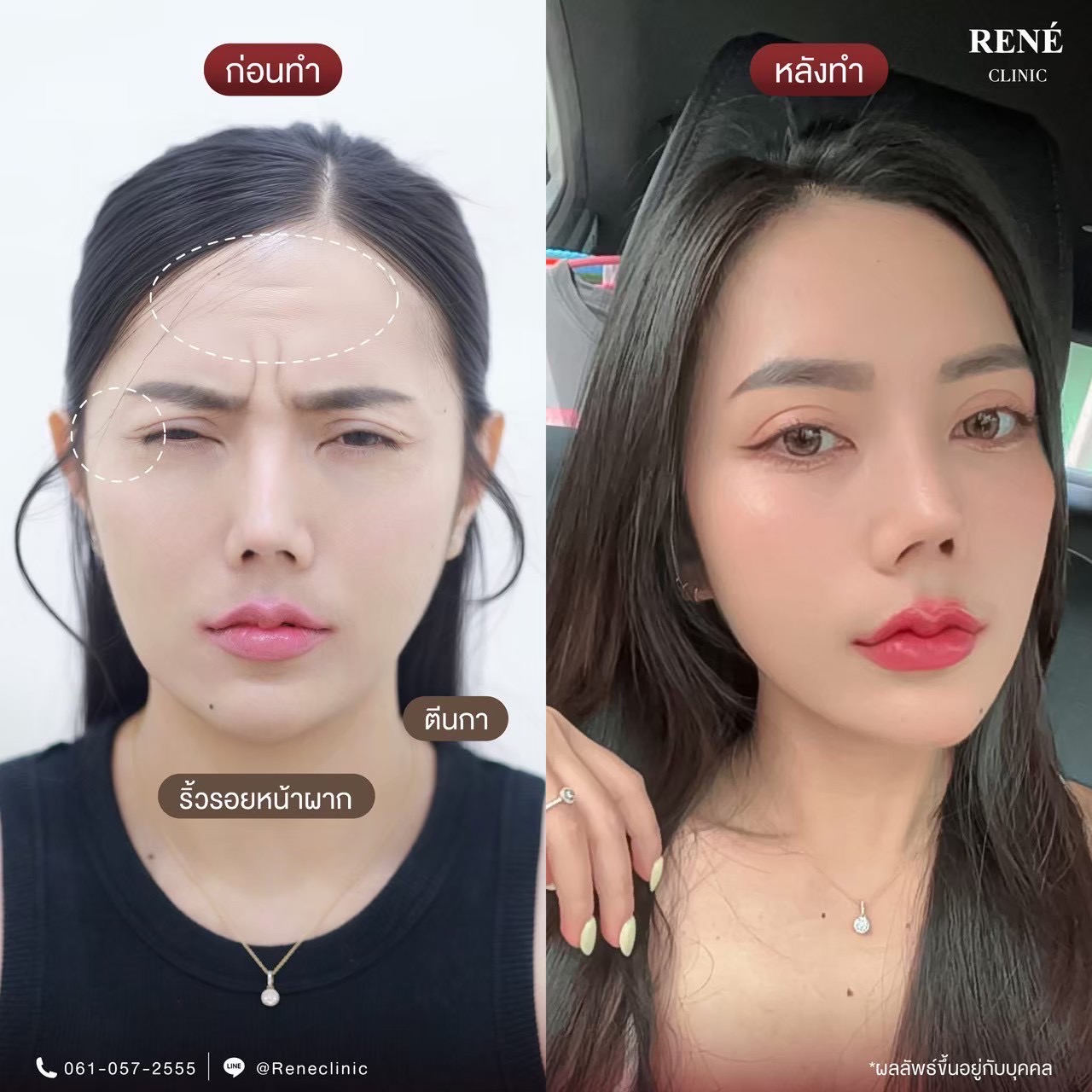 รีวิว Botox #20