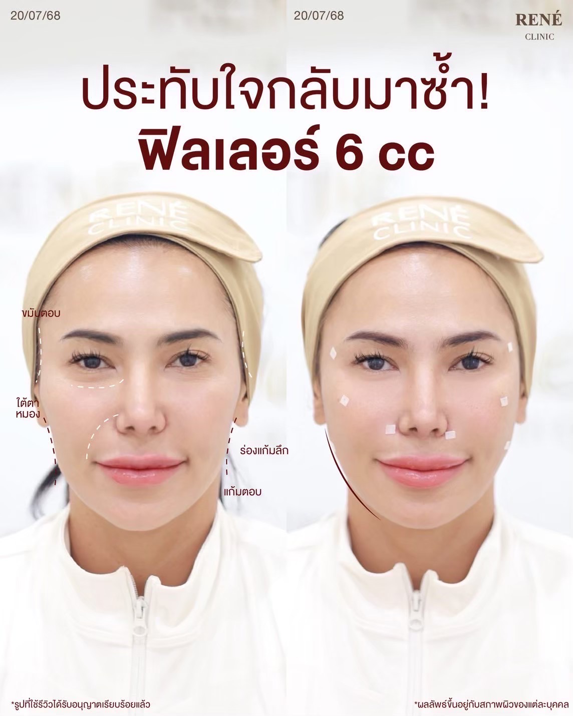 รีวิว Filler #1