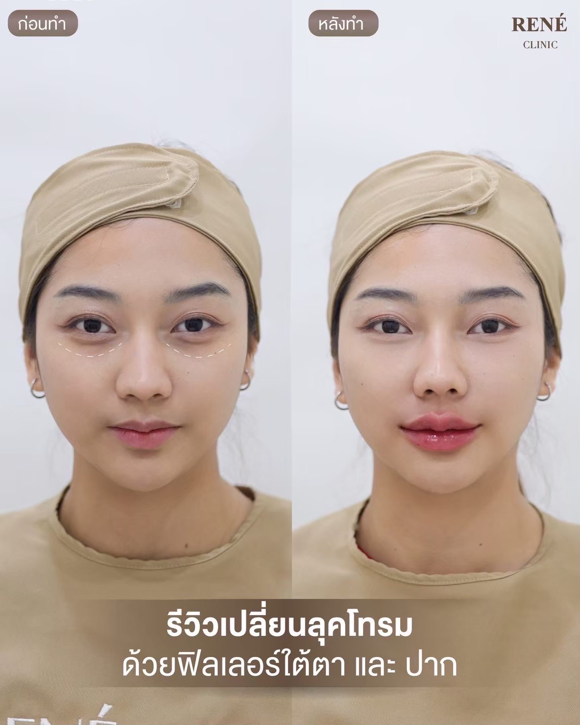 รีวิว Filler #10