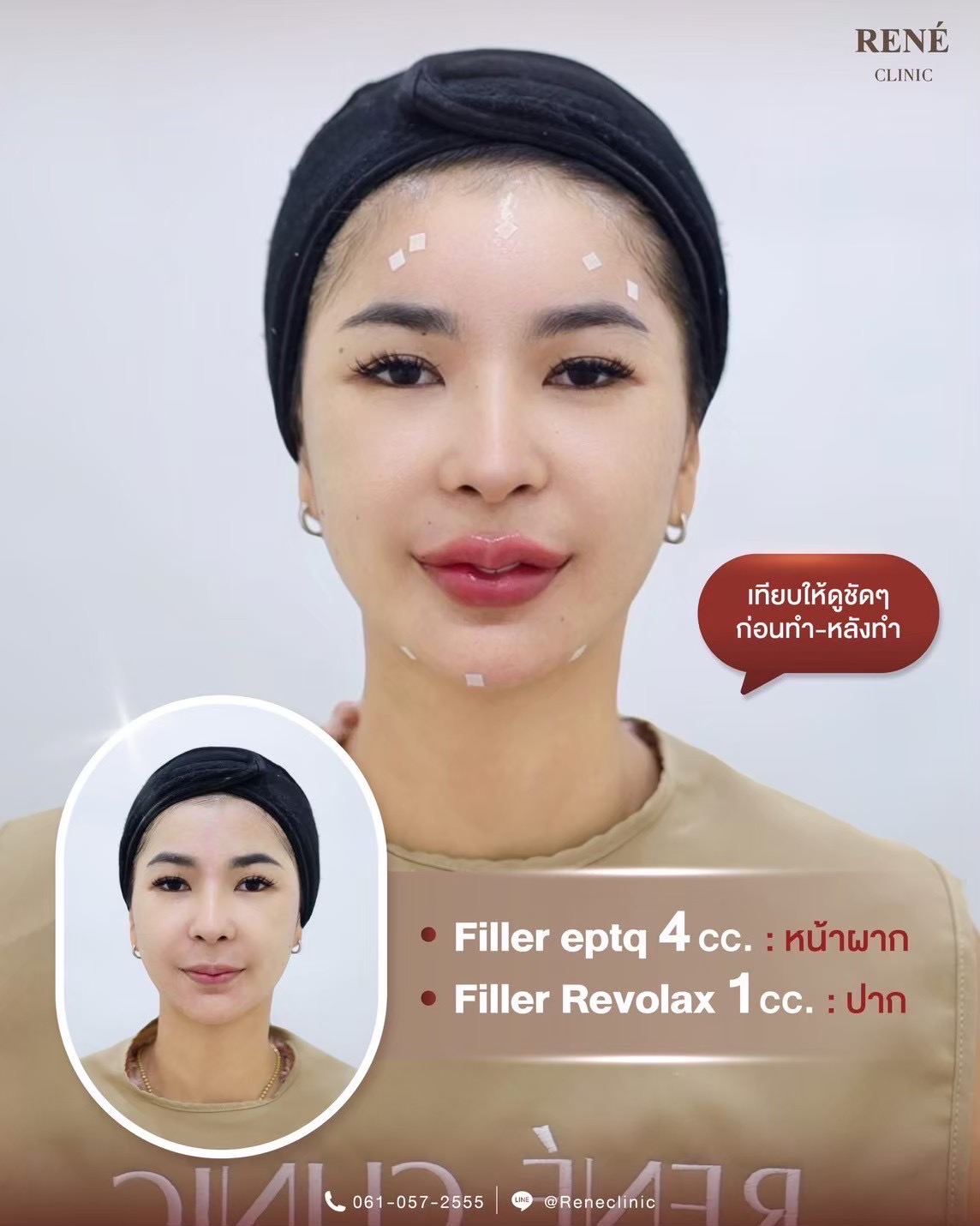 รีวิว Filler #11