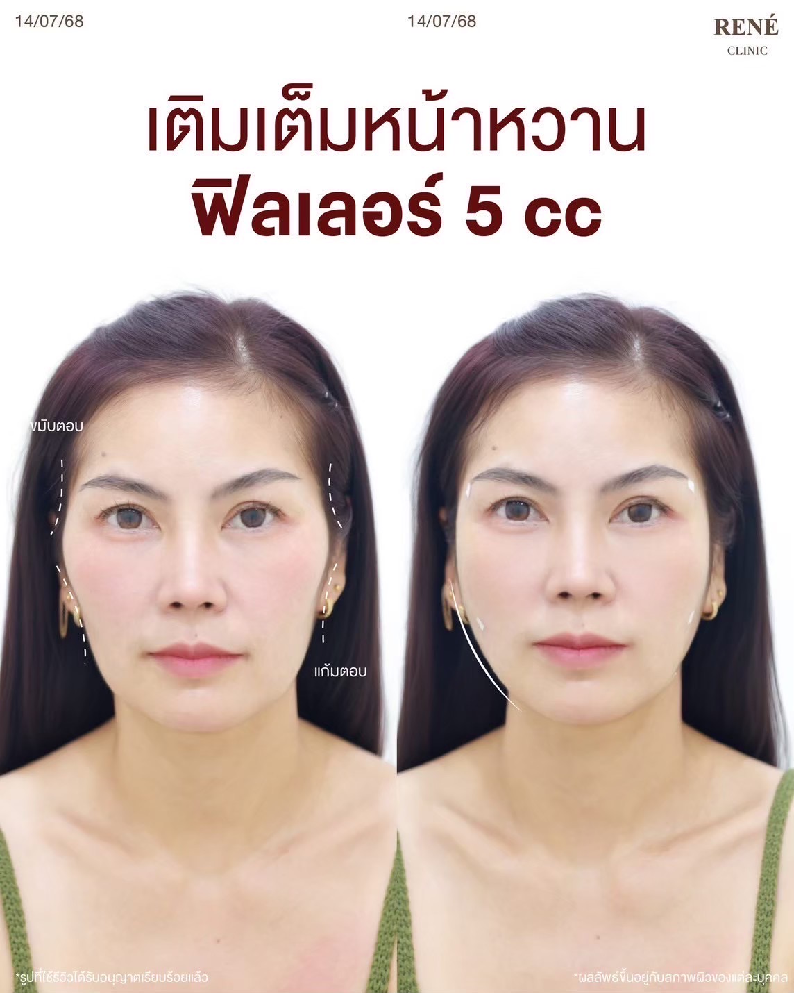 รีวิว Filler #12