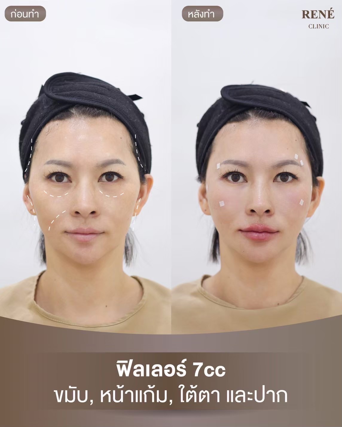 รีวิว Filler #13