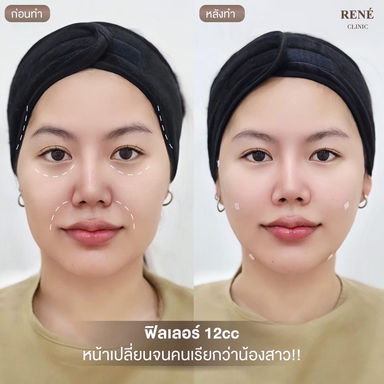รีวิว Filler #14