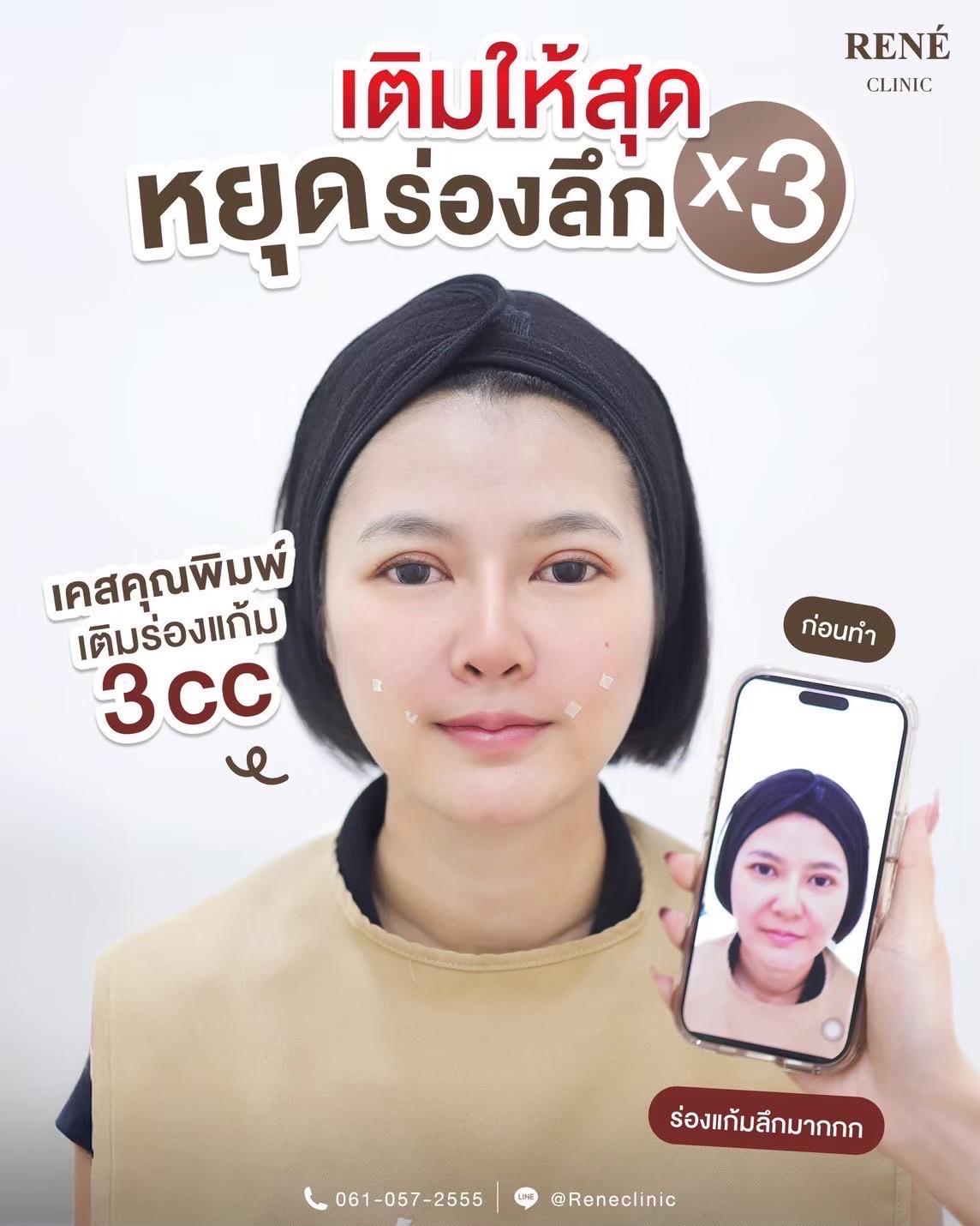 รีวิว Filler #15