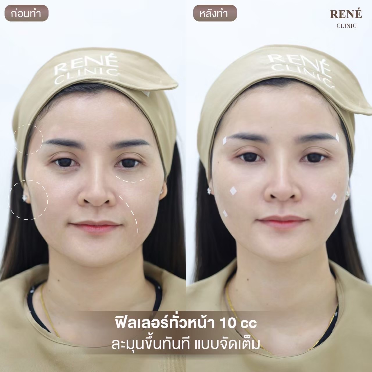 รีวิว Filler #16