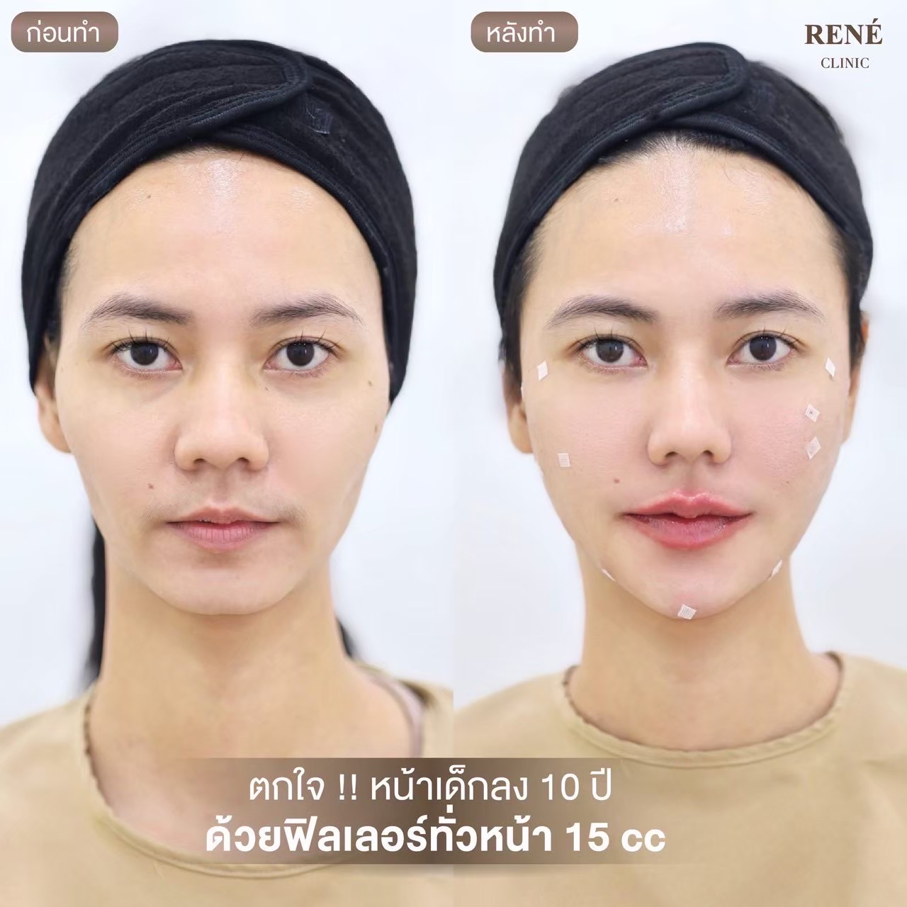 รีวิว Filler #17