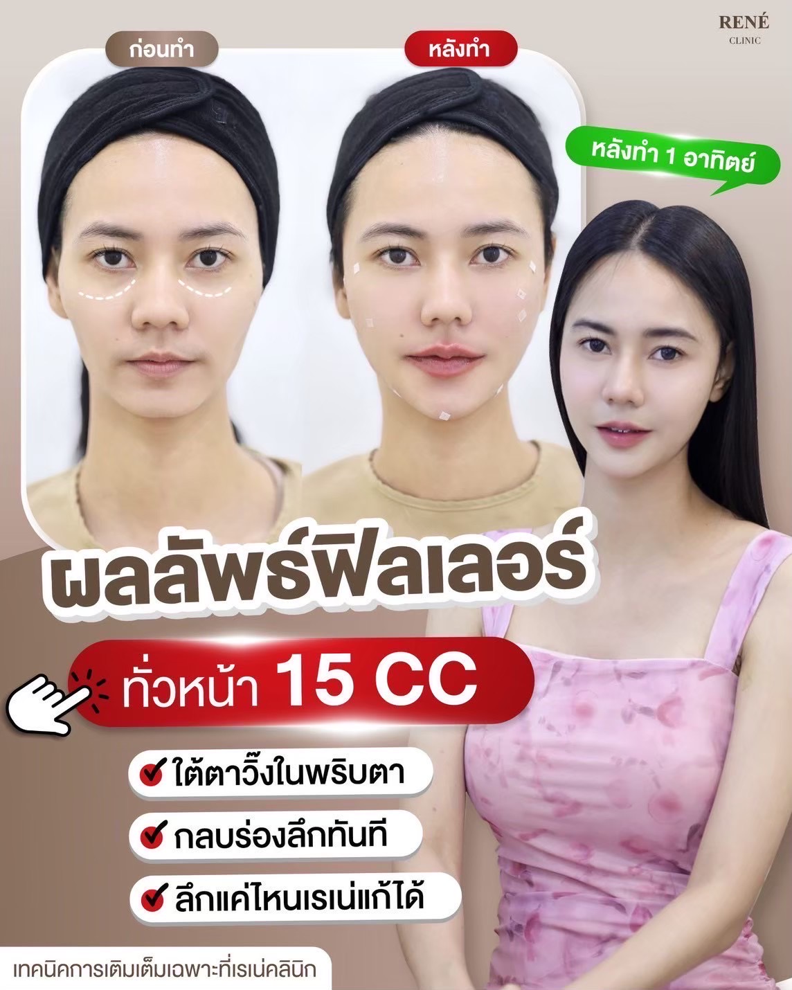 รีวิว Filler #19