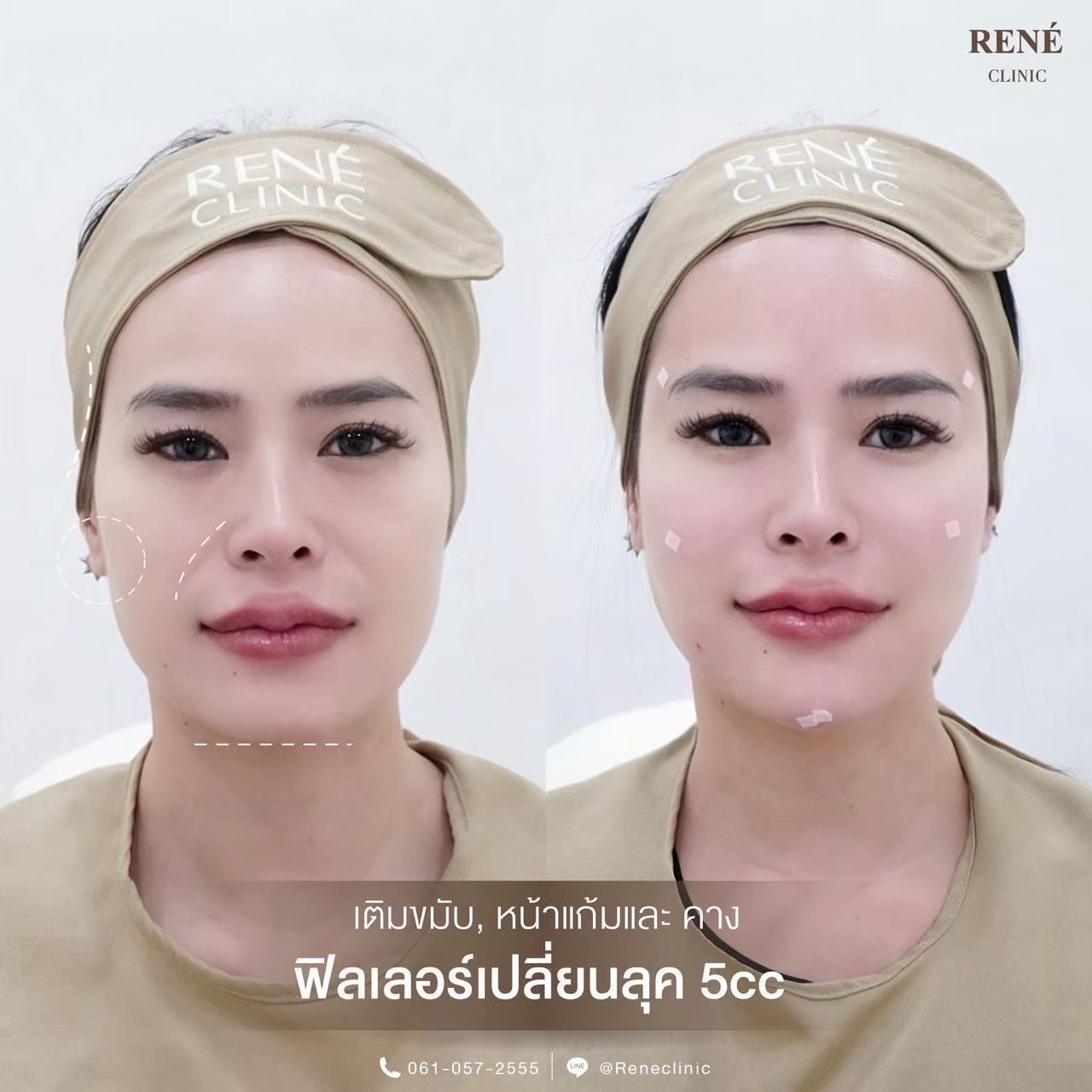 รีวิว Filler #20