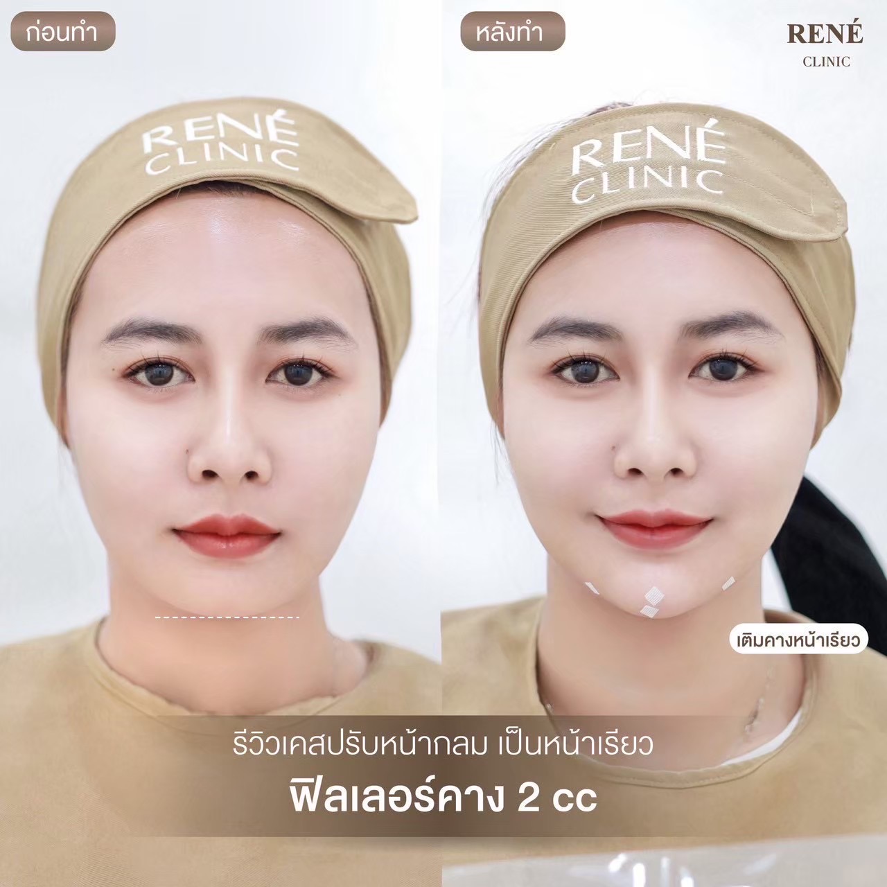 รีวิว Filler #21