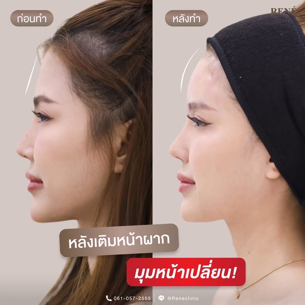 รีวิว Filler #22