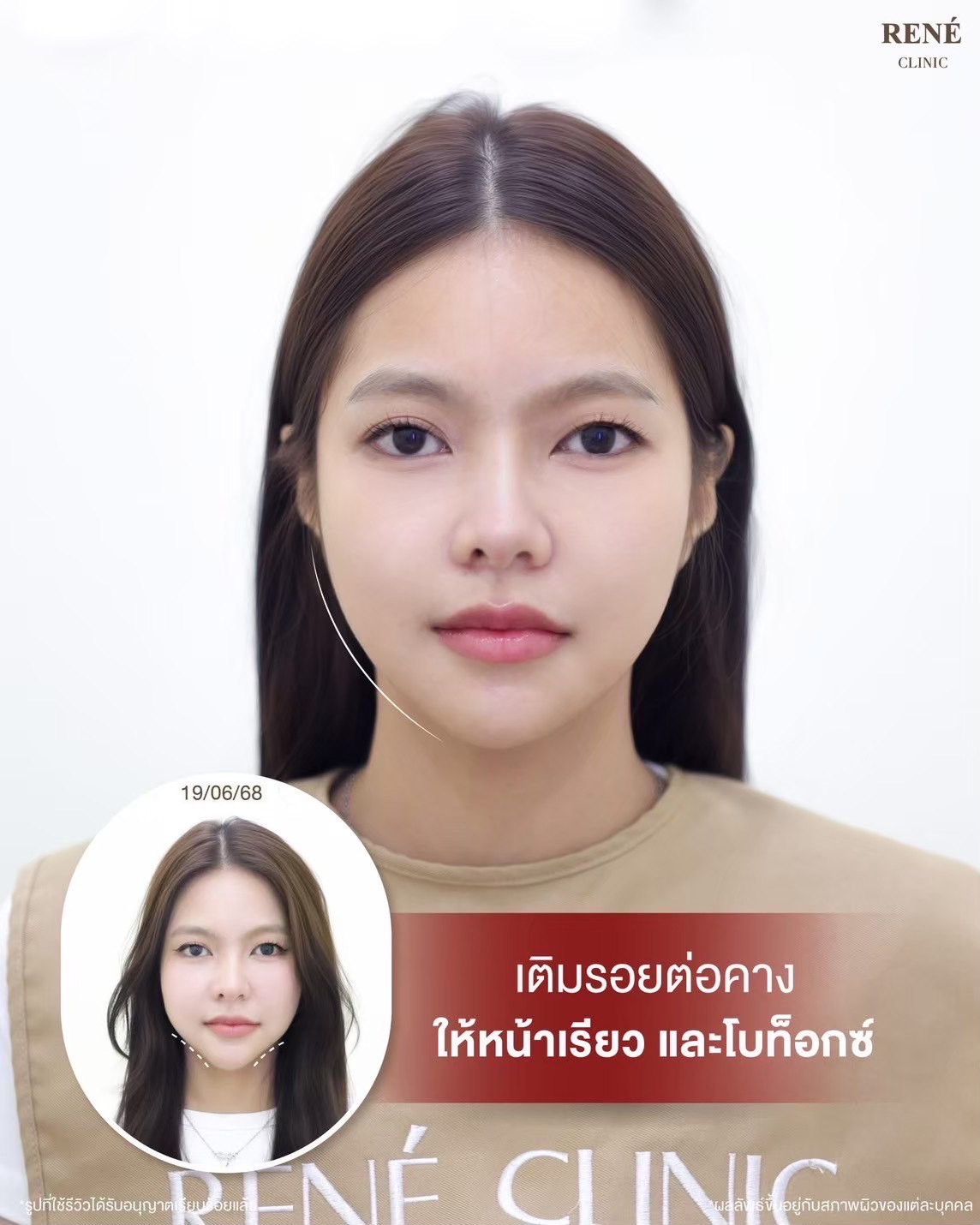รีวิว Filler #23