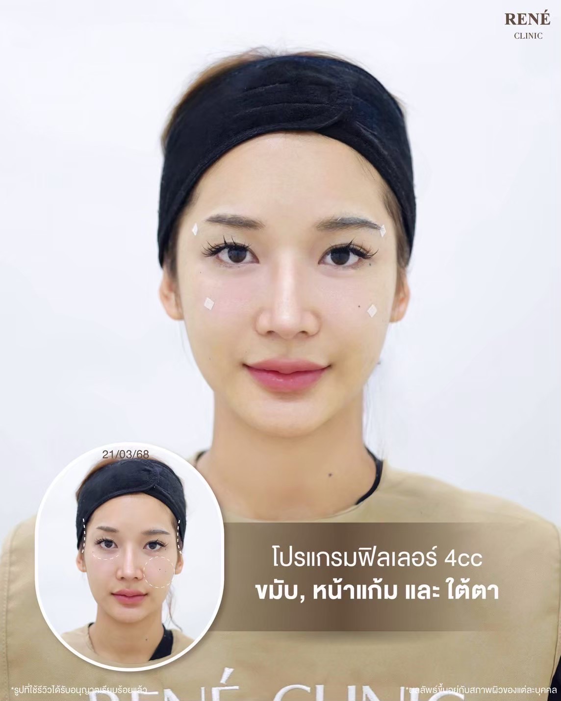 รีวิว Filler #4