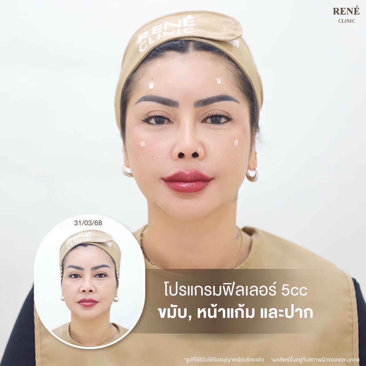 รีวิว Filler #6