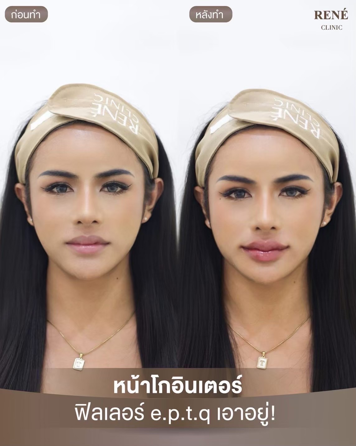 รีวิว Filler #7