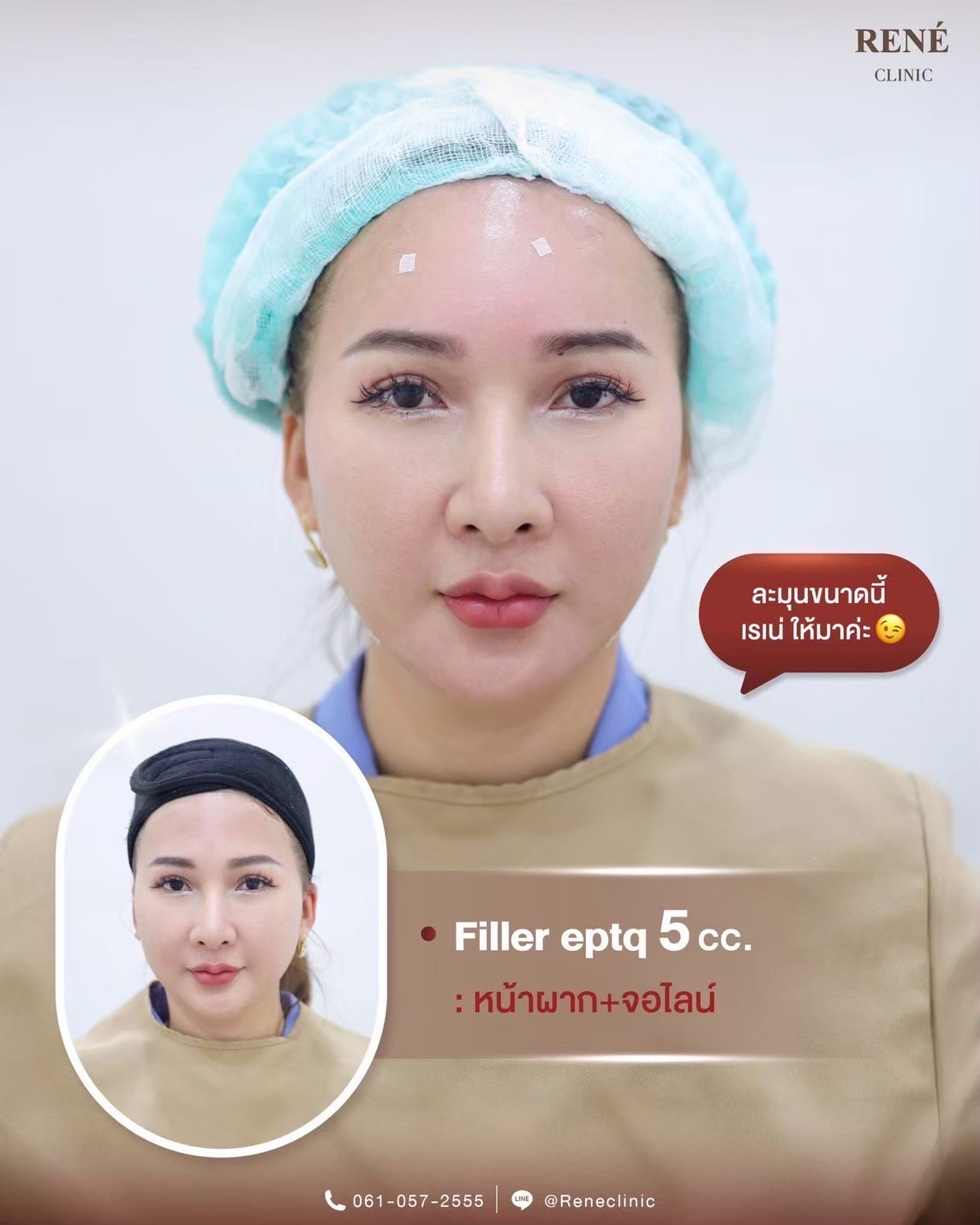 รีวิว Filler #8