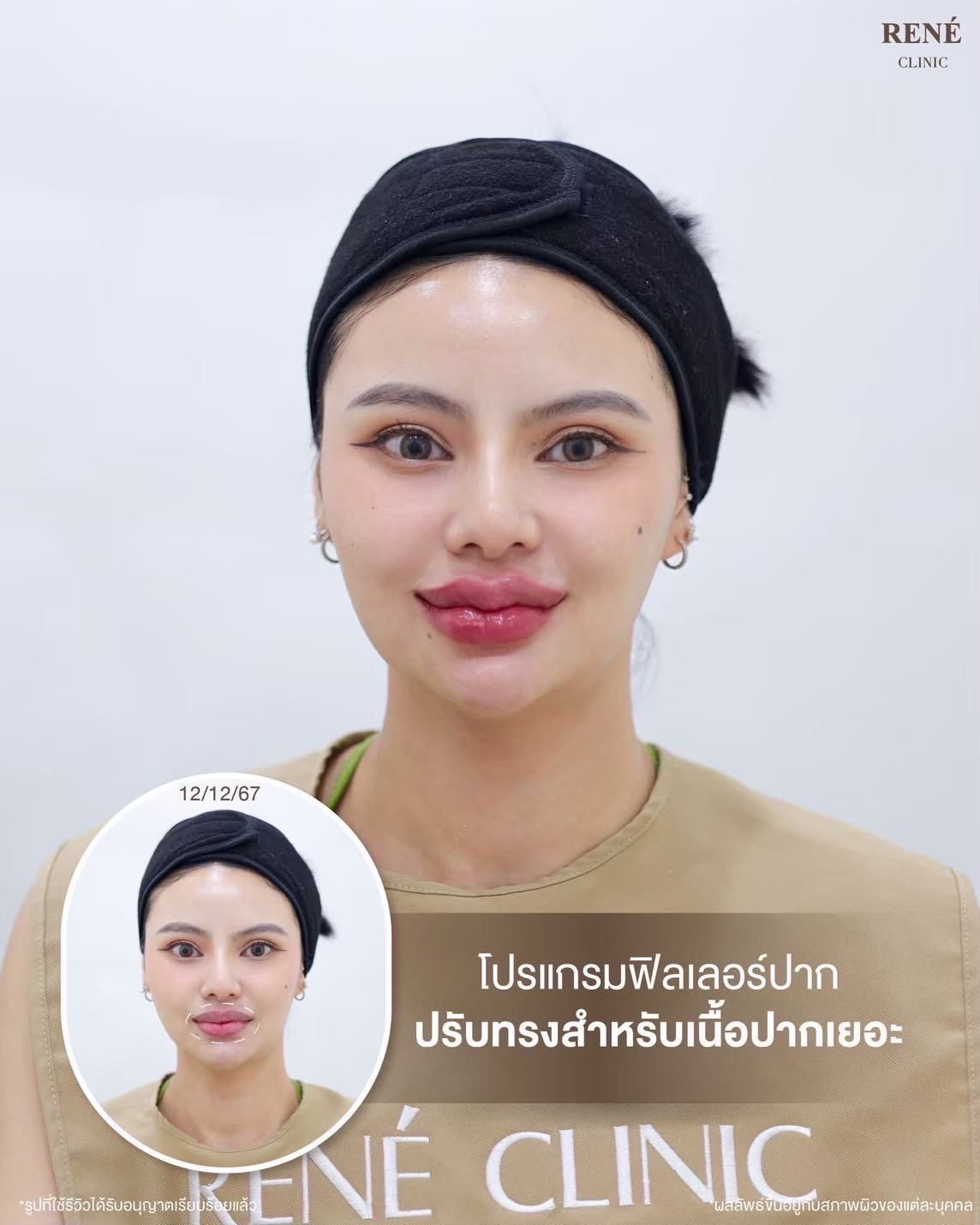 รีวิว Filler #9